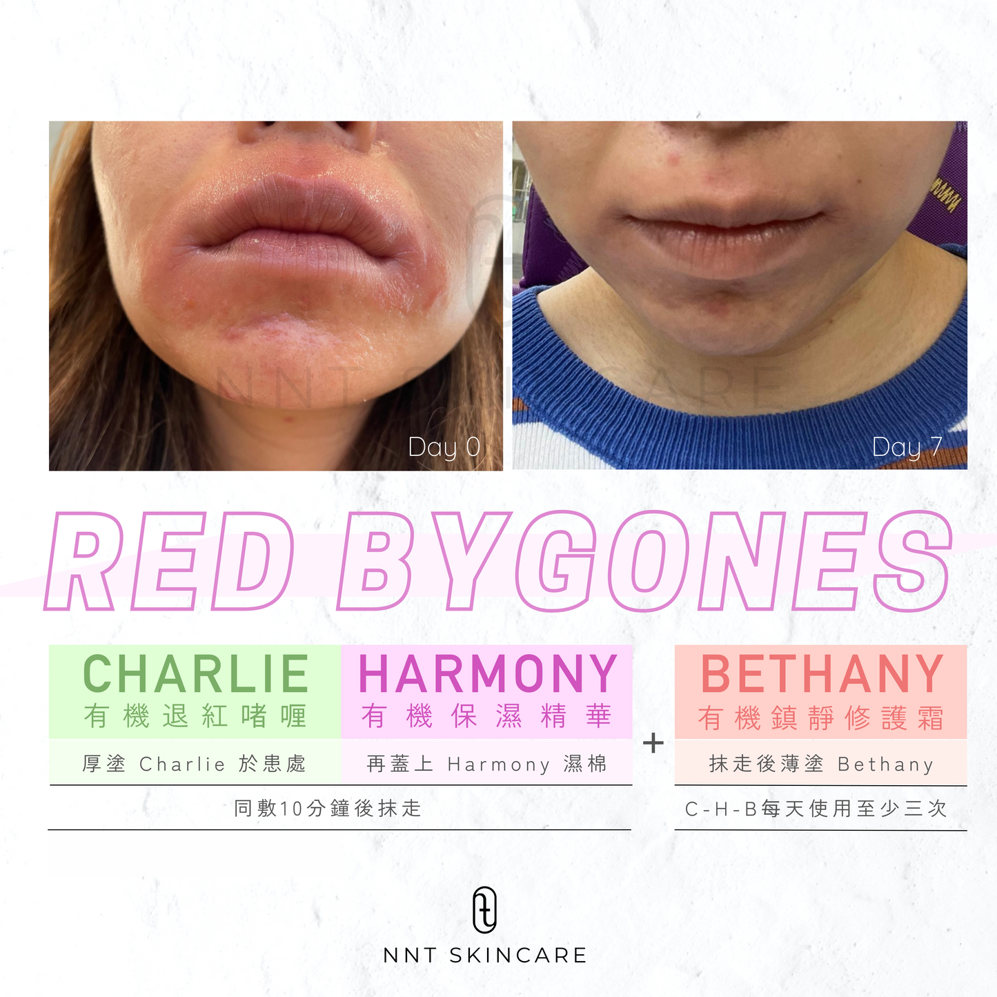Red Bygones 退紅抗敏套裝